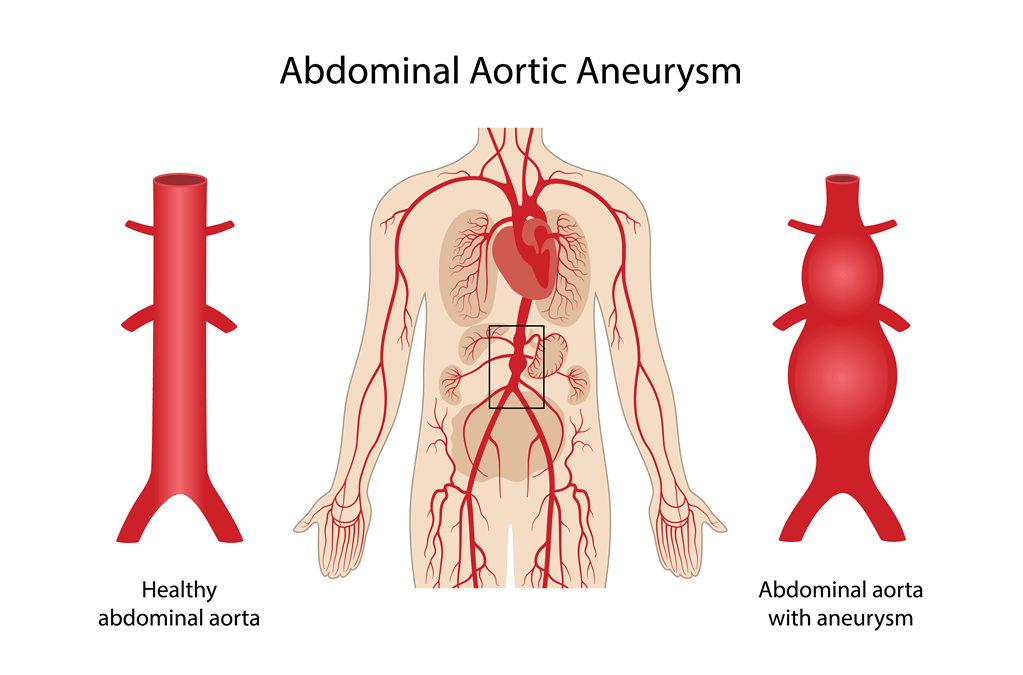 Abdominal Aort Anevrizması