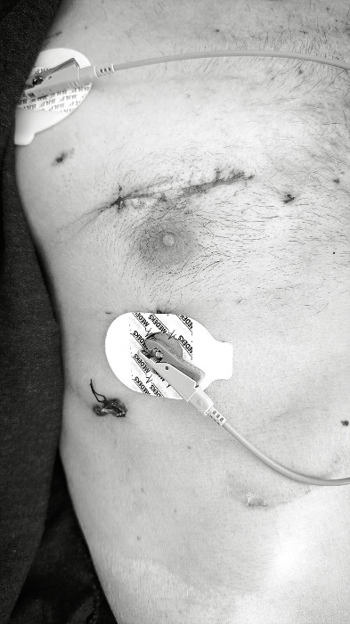 Sağ Minitorakotomi İle Mitral Kapak Replasmanı